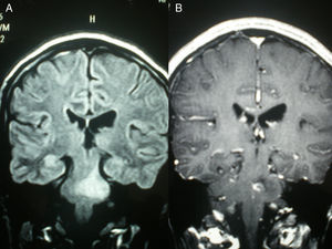 Resonancia magnética craneal corte coronal en secuencias FLAIR (A) que muestra una lesión hiperintensa protuberancial extensa y T1 con contraste (B) que muestra captación de la lesión.
