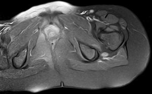 RM en incidencia axial ponderada en T1 supresión de grasa tras la administración de gadolinio intravenoso. Se objetiva captación intensa y homogénea de la lesión del nervio ciático.