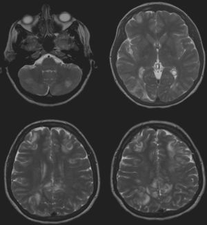 Axial T2. Áreas parcheadas de hiperintensidad de señal en ambos hemisferios cerebelosos, parietooccipital derecho y frontal bilateral, de predominio subcortical con afectación de la corteza sin engrosamiento de la misma. Distribución de las lesiones en territorio frontera vascular.