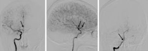 Arteriografía. Se observan signos de vasoespasmo generalizado, especialmente llamativo en ambas cerebrales anteriores (izquierda), de la carótida interna izquierda supraclinoidea (centro) y de toda la circulación posterior (derecha).