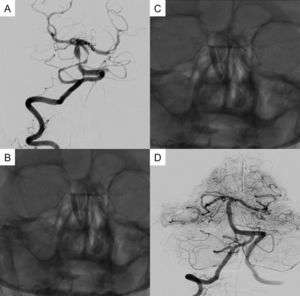 A) Angiografía cerebral que muestra estenosis crítica de arteria basilar. B, C) Colocación de stent con balón expandible Pharos. D) Control angiográfico final que evidencia revascularización de arteria basilar.
