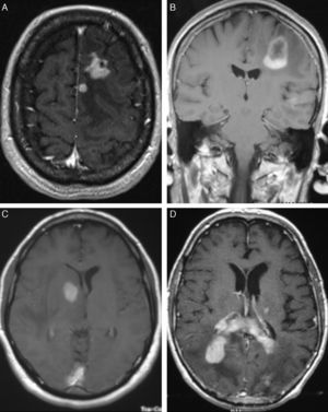 Diferentes patrones de captación de gadolinio en resonancia magnética, secuencias T1 con gadolinio. A. lesiones adyacentes a planos piales, B. lesión solitaria, C. tumor en núcleo basal (caudado), D. infiltración del cuerpo calloso..