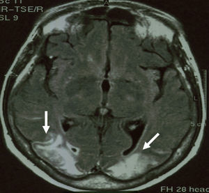 RMC en tiempo FLAIR. En el corte axial se observan lesiones hiperintensas bilaterales (flechas blancas), cortico-subcorticales extensas, en ambos lóbulos occipitales.
