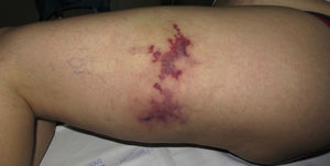 Placa purpúrico-violácea con morfología livedoide.