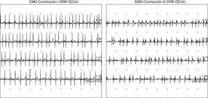 Denervación activa aguda en ambos orbiculares de los ojos (más significativa en el lado izquierdo).