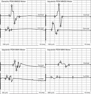 Potenciales evocados motores normales registrados en el músculo abductor corto del pulgar en miembros superiores (MMSS) y en el músculo tibial anterior en miembros inferiores (MMII).