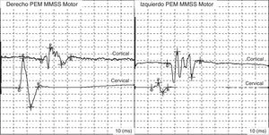 Potenciales evocados motores anormales, registrados en el músculo abductor del pulgar en miembros superiores (MMSS): aumento de la latencia del PEM cortical (derecho: 24,5ms; izquierdo: 30ms) y aumento del tiempo de conducción central (TCC) (derecho:16.5ms; izquierdo:11.8ms).