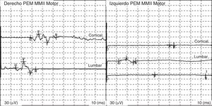 Potenciales evocados motores anormales, registrados en miembro inferior izquierdo (músculo tibial anterior): ausencia de PEM por estimulación cortical.