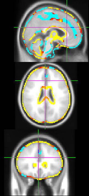 Atrofia cerebral comparativa entre los varones y las mujeres. En color azul se muestran las zonas de atrofia en el seguimiento longitudinal, en las mujeres comparativamente con los varones, mientras que en color amarillo/rojo se observan las zonas de atrofia cerebral en los varones comparativamente con las mujeres. Los colores presentes en esta figura únicamente pueden apreciarse en la versión electrónica del artículo.