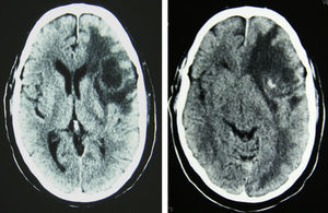 Tomografía computarizada cerebral sin contraste que muestra lesión ocupante de espacio fronto-temporal izquierdo con importante edema perilesional y desviación de línea media.
