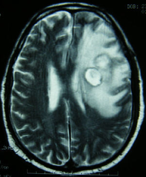 Resonancia magnética cerebral en secuencia T2.