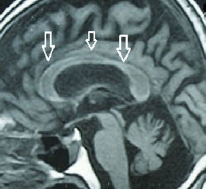 Resonancia magnética craneal que muestra la atrofia de todo el cuerpo calloso en toda su extensión, como muestran las flechas blancas; corresponde al paciente con el curso clínico crónico.