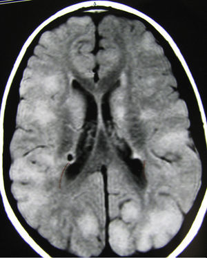 Corte axial de la RM en la que se observa gran cantidad de tuberosidades de pequeño-mediano tamaño en ambos hemisferios.