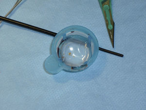 Material embólico extraído tras el implante de stent carotídeo mediante dispositivo de protección proximal MoMa.