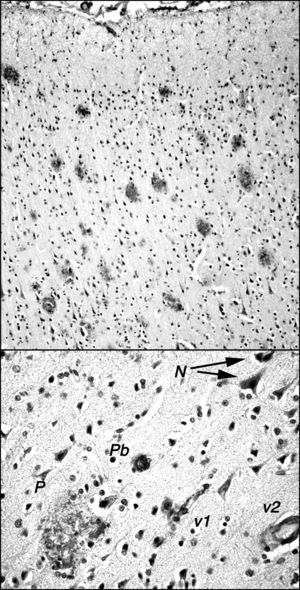 Placas amiloides en la corteza frontal de cerebro de un ejemplar de macaco de cola de tirabuzón (Macaca arctoides) de 34 años de edad, del Centro Internacional de Restauración Neurológica (CIREN), con déficit cognoscitivo-comportamental significativamente mayor que ejemplares «normales» de su misma edad. Las placas están marcadas con el anticuerpo 6E10 (Chemicon) que reconoce el epítopo 3-8 del péptido amiloide humano. En la parte superior se muestra la gran densidad de placas existentes en la corteza frontal, generalmente de tipo difuso no neurítico y sin core central, y con escasa gliosis. En la parte inferior, se muestra algunos otros depósitos amiloideos: N: acumulaciones granulares pequeñas intraneuronales; P: placa multiforme en la que se incluyen células de tipo glial y estructuras de muy diversa densidad de inmunorreacción; Pb: placa tipo burnt out de los enfermos de Alzheimer; v1: reacción amiloide adosada a un vaso de pequeño calibre y a las células que lo rodean; v2: reacción amiloide en las paredes de un vaso de mediano calibre.