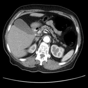 Tomografía computarizada abdominal con contraste en fase portal temprana: masa retroperitoneal adyacente a la tercera porción del duodeno, sin masas en el ovario o los anejos.
