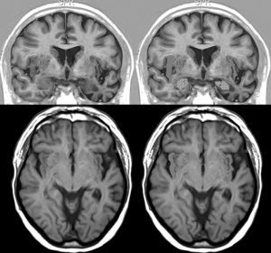Resonancia magnética cerebral de un paciente con DFT y bradicardia. Varón de 67 años con DFT–demencia semántica en estadio intermedio y 56ppm. Muestra atrofia destacada del lóbulo temporal izquierdo. Arriba: sección coronal en inversion recovery y abajo sección axial en FLAIR. En la parte derecha aparece la corteza insular rayada y la amígdala punteada.