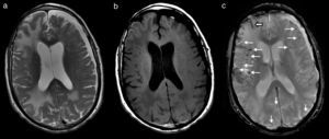 RM cerebral que muestra lesiones hiperintensas en T2 (a) e hipointensas en T1 (b), correspondientes a amplias áreas de edema vasogénico subcortical occipitoparietal y frontal derecho, y de forma más limitada parietooccipital izquierdo. En secuencia eco de gradiente potenciada en T2* (c) se observan múltiples focos de depósito siderótico milimétricos, de predominio cortical difusos (flechas finas) y restos de siderosis leptomeníngea subaracnoidea (flecha gruesa). Existe una atrofia corticosubcortical con marcada dilatación involutiva de espacios perivasculares de Virchow-Robin y un higroma subdural frontoparietal izquierdo.