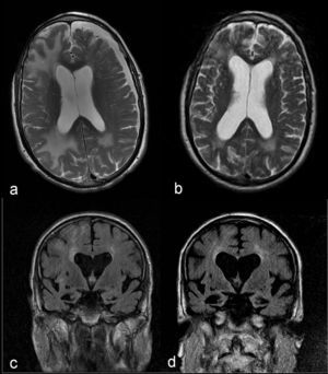 Imágenes comparativas en secuencia T2 axial donde se observa una notable disminución en el tamaño de las lesiones de la sustancia blanca y resolución del higroma subdural entre la RM cerebral realizada en el momento agudo (a) y un mes y medio después (b). Imágenes comparativas en FLAIR coronal que muestran la progresión de la atrofia cerebral y de hipocampos, y la dilatación ventricular secundaria entre la RM cerebral realizada en el momento agudo (c) y 6 meses después (d).