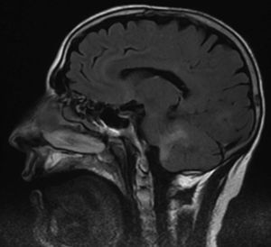 . RM cerebral, secuencia T1. Lesión de aspecto inflamatorio de los pedúnculos cerebelosos protuberanciales.
