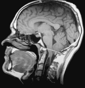 Imagen de resonancia magnética (proyección sagital potenciada en T1) de un paciente con malformación de Chiari tipo I que presenta un descenso de las amígdalas cerebelosas de 9mm por debajo del foramen occipital.