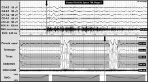 Apneas centrales en un paciente con malformación de Chiari tipo I. Registro polisomnográfico nocturno con presencia de apneas centrales (incluidas en las franjas grises). La línea gris al final del evento respiratorio (flecha) indica el inicio del microdespertar cortical, que se visualiza en los canales de electroencefalografía con una escala de tiempo diferente. La parte inferior de la figura muestra el descenso de la saturación de oxígeno secundario a la apnea.