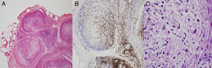 A) Inflamación perivascular y perineural en HE 20×. B) Abundantes linfocitos (CD45 a 20×). C) Fite 100× con bacilos en macrófagos.