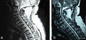 a) Secuencia T2 de la resonancia magnética cervical previa a la cirugía de hernia discal cervical C3-C4. b) Secuencia T2 de la resonancia magnética cervical posterior a la cirugía de hernia discal cervical.