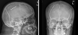 Radiografía simple de cráneo lateral y anteroposterior donde se observa la localización del electrodo de estimulación cortical a nivel interhemisférico.