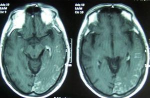 Imagen de RM en secuencia T1 con gadolinio mostrando la malformación vascular leptomeníngea afectando a los lóbulos occipital, temporal y parietal izquierdos.