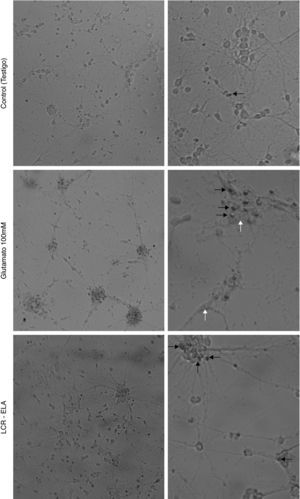 Cambios celulares en el cultivo de neuronas motoras tras la exposición a control, glutamato 100mM y LCR-ELA. En el control, la flecha negra indica células picnóticas. En el cultivo expuesto a glutamato, las flechas blancas señalan vacuolas autofágicas, y en las flechas negras condensación de cromatina. En el cultivo expuesto a LCR-ELA, las flechas negras indican mantenimiento de la membrana citoplasmática.