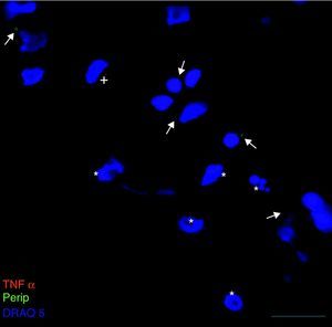 Co-expresión de TNFα y periferina en el cultivo de LCR-ELA. Las flechas indican inclusiones de periferina positivas en células que no expresan TNFα, y células TNFα positivas (+), el asterisco (*) muestra las células con degradación nuclear. Barra:30 micras.