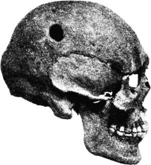 Cráneo prehistórico con un orificio de trepanación.