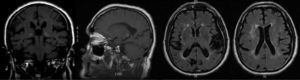 RM cerebral. Secuencias potenciadas en T1 coronal y sagital, así como FLAIR axial. Hiperintensidad en T1 en ambos núcleos pulvinares.
