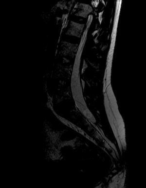 Imagen de resonancia magnética espinal ponderada en T2 en corte sagital de región lumbo-sacra. Se observa una lesión redondeada de 16mm de diámetro en la región distal del canal raquídeo intradural a la altura del espacio S1, hiperintensa en T2, con un centro de menor intensidad de señal, compatible con lesión de cisticercosis en fase vesicular o coloidal. En el resto de la columna no hay evidencia de lesiones intra o extramedulares.