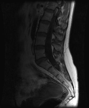 Imagen de resonancia magnética espinal en corte sagital de región lumbo-sacra. Misma lesión en secuencia T1, delimitándose una cápsula y una pequeña imagen satélite nodular de morfología alargada, compatible con fase vesicular o coloidal.