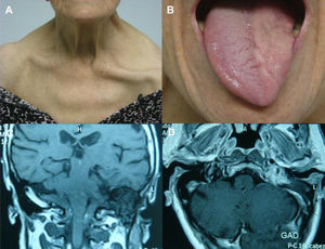 Síndrome de Collet-Sicard. A) Parálisis del xi par craneal izquierdo con descenso del hombro y protrusión clavicular. B) Parálisis del xii par craneal izquierdo con atrofia hemilingual. C) Lesión tumoral localizada en el foramen yugular interno izquierdo. D) Realce de la lesión en el estudio RM con gadolinio.