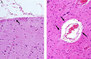 Presencia de cuerpos amiláceos (flechas) en la neocorteza de pacientes con epilepsia del lóbulo temporal farmacorresistente. A) Superficie meníngea (grado 1). B) Alrededor de un vaso sanguíneo con espacio de Virchow-Robin dilatado (sustancia blanca, grado 3). H/E×400.