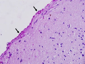 Acumulación difusa de cuerpos amiláceos (flechas) en la neocorteza (superficie meníngea, grado 3) de un paciente con epilepsia del lóbulo temporal farmacorresistente. PAS×400.