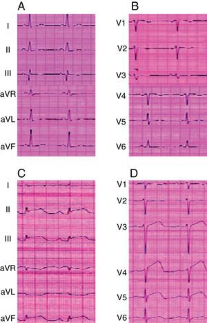 A y B) El electroencefalograma (ECG) preoperatorio no presentaba alteraciones. C y D) El ECG tras la tercer-ventriculostomía endoscópica reveló alteraciones típicas del síndrome de corazón contundido (elevación del segmento ST e inversión de la onda T).
