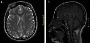 Resonancia magnética cerebral con gadolinio en límites normales. A) Secuencia axial en T2. B) Secuencia sagital en T2 Flair.