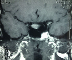 RM T1 corte sagital previa a la cefalea.