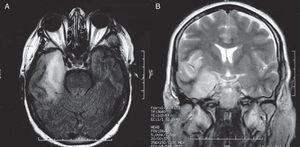 Probable diagnóstico de encefalitis temporal derecha en RM. Corte axial de RM potenciado en T1 y coronal potenciado en T2, que muestra una lesión hiperintensa en el lóbulo temporal y el córtex insular derecho, con un patrón típico de encefalitis herpética, realizado 20 días después de la cirugía de meningioma paraselar.
