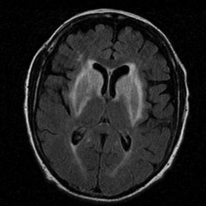 RM cerebral con afectación simétrica de ambos núcleos estriados y brazos anteriores de cápsulas internas, con aumento de señal en secuencia FLAIR.