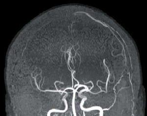 Imagen de angio-RM en las que se observa permeabilidad del árbol arterial y una vena cortical superficial que se rellena precozmente a nivel frontal izquierdo.