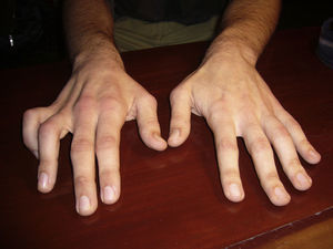 Paciente 1. Amiotrofia de los interóseos dorsales de la mano derecha con tendencia a la garra cubital.
