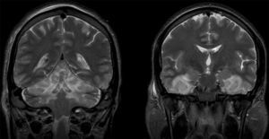 RMN craneal. Corte coronal de RMN cerebral potenciada en T2 que muestra lesiones anóxico-isquémicas múltiples de carácter subagudo-precoz. Las lesiones afectan de manera extensa a ambos sistemas límbicos, hipocampos, fórnices y áreas temporales basales. Pequeñas zonas parcheadas en lóbulos frontales y parietales. Extensas lesiones en ambos hemisferios cerebelosos. Catéter de derivación ventricular en VL derecho.