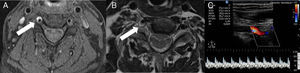 Cortes axiales de resonancia magnética cervical (A, B): secuencia T1 de saturación grasa (A) que muestra una hiperintensidad rodeando la arteria vertebral derecha a nivel de C5 (flecha) compatible con un hematoma intramural. La imagen potenciada en T1 (B) pone de manifiesto la compresión de la raíz C5 (flecha) a causa de la expansión del hematoma. El doppler color de la arteria vertebral derecha en su porción extracraneal (C) muestra un flujo bifásico en el segmento V2 y un incremento de la pulsatilidad. No se observa flujo en el segmento V1.