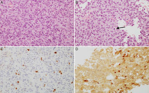 A y B) Imágenes microscópicas de un adenoma hipofisario atípico productor de prolactina. Se trata de un tumor moderada a densamente celular, compuesto por células de núcleo grande y ocasionalmente pleomórfico, nucléolo prominente y moderada cantidad de citoplasma eosinófilo pálido. Se observan figuras mitóticas dispersas (flecha) (hematoxilina-eosina 200×). El adenoma muestra elevado índice de proliferación celular (4%) (C, Ki67 200×) e inmunorreactividad citoplasmática en algunas células para prolactina (D, PRL 200×).