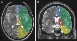 Áreas de irrigación cerebrales. A: corte axial, B: corte coronal. 1: arteria cerebral anterior, 2: arteria cerebral media, 3: arteria cerebral posterior, 4: arteria coroidea anterior, 5; arterias lenticuloestriadas.
